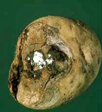 potato dry rot disease